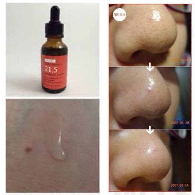 SERUM VITAMIN C21.5 TRỊ MỤN TRẮNG DA